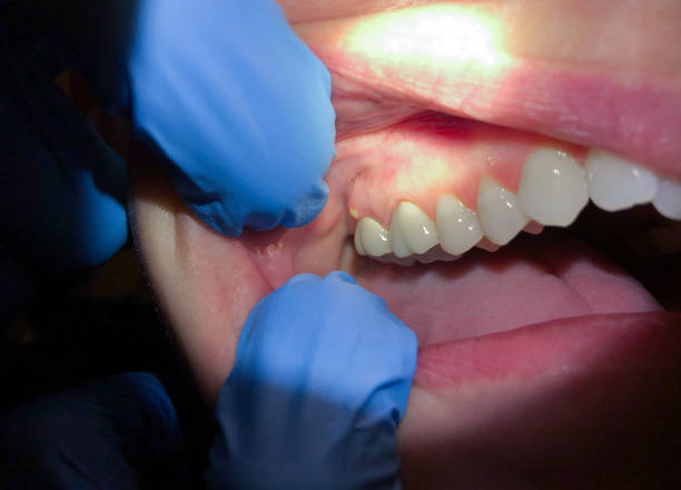 Best Dental Abscess Treatment in Rosemont, CA